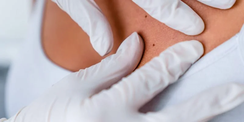 Primer plano de unas manos con guantes médicos examinando la piel de una persona. Se observan pequeños lunares mientras se realiza una revisión dermatológica en un entorno clínico.